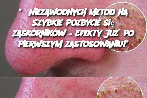 “5 Niezawodnych Metod na Szybkie Pozbycie się Zaskórników – Efekty Już po Pierwszym Zastosowaniu!”