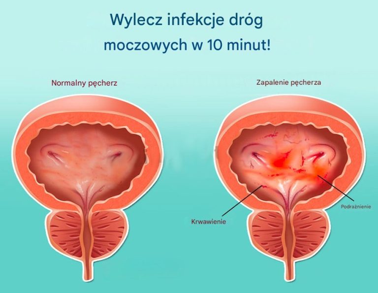 Jak wyleczyć infekcje dróg moczowych w 10 minut!