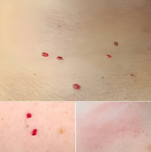 Jeśli zauważysz te czerwone kropki na swojej skórze, oto co one oznaczają