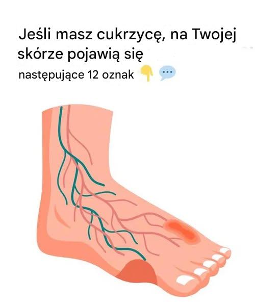 12 dziwnych problemów skórnych związanych z cukrzycą, o których musisz wiedzieć