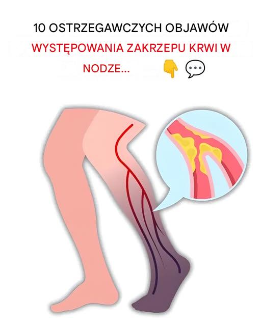 10 najważniejszych oznak zakrzepu krwi w nodze (zapobieganie zakrzepicy żył głębokich)