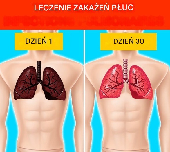 6 naturalnych sposobów leczenia infekcji płuc (domowe sposoby)